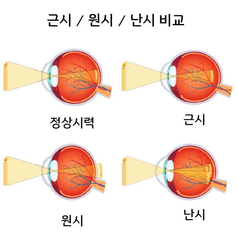 초고도근시·초고도난시, 기준부터 검사 시 확인 포인트까지 정리