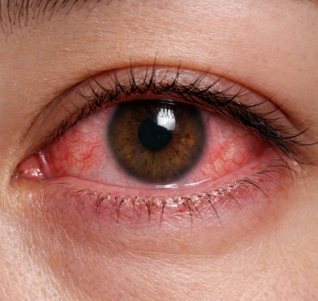 눈이 빨갛게 충혈됨을 나타난 이미지