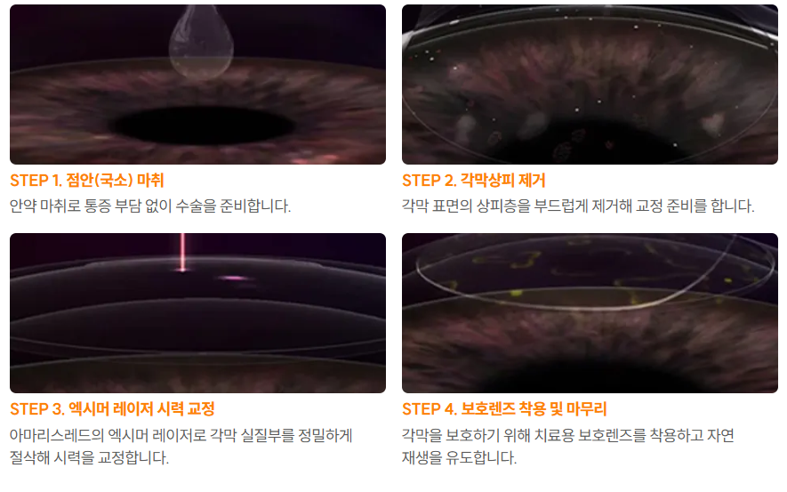 라섹통증을 설명하기 위한 수술 과정