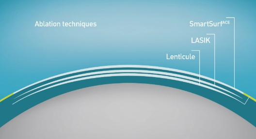 라섹부작용을 줄이는 아마리스 레드 장비의 테크닉