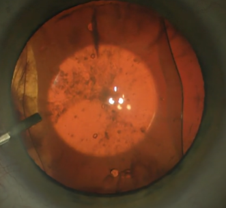 렌즈삽입술제거를 진행하는 장면