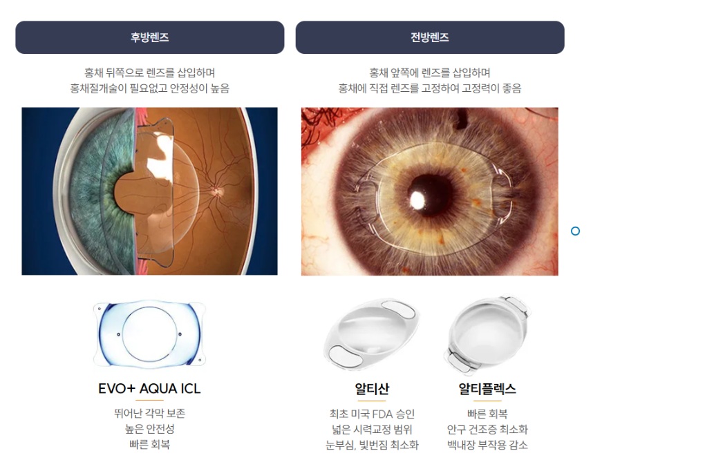 렌즈삽입술회복기간 관련 설명 이미지