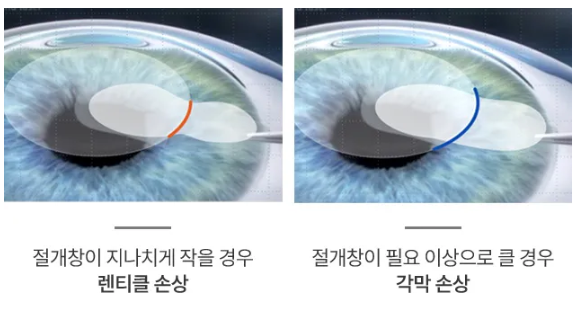 스마일라식각막두께 외에 놓치지 쉬운 부분 중 하나인 의료진의 실력에 대해서 설명하는 이미지