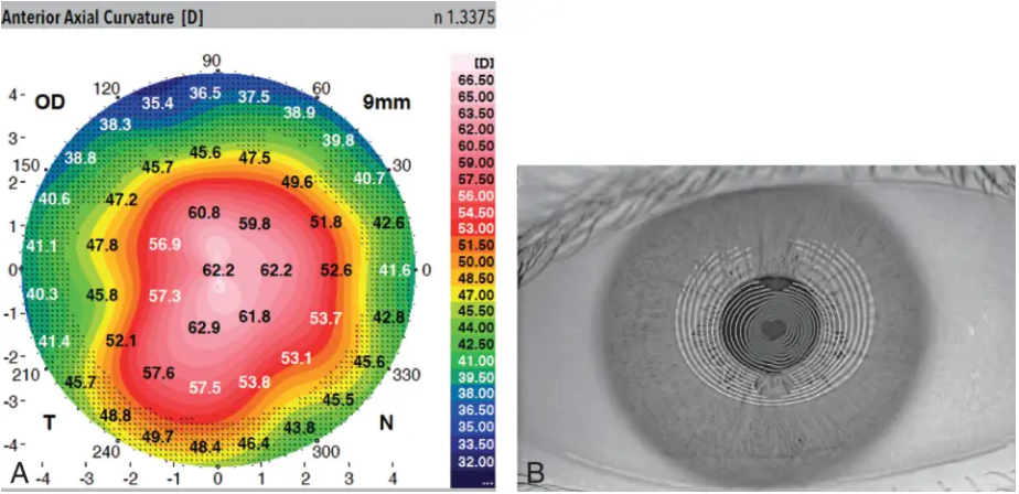 라식나이 보다 정밀검진을 우선해야 하는 이유를 설명하는 이미지