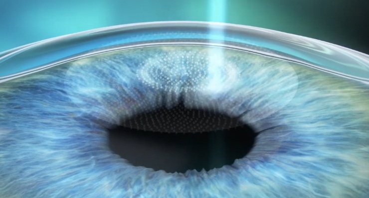 스마일라식통증 어느 정도일까? 수술 직후부터 3일차까지 실제 체감 강도