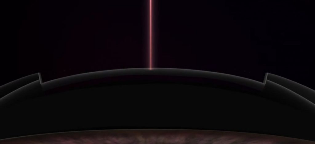 라섹일주일후 시력 상태를 설명하기 위한 이미