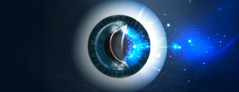 초고도근시스마일라식 가능할까? 수술 가능한 기준과 실제 교정 범위