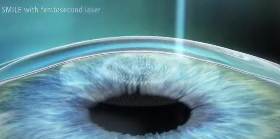 스마일라식수술비용을 설명하기 위한 스마일라식 수술 과정 이미지