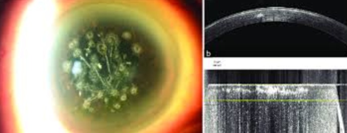 아벨리노검사 없이 시력교정술을 진행했을 때 나타나는 현상