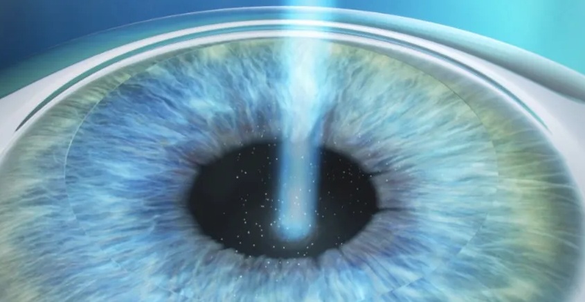 라섹수술회복기간을 이해하기 위한 수술과정 설명