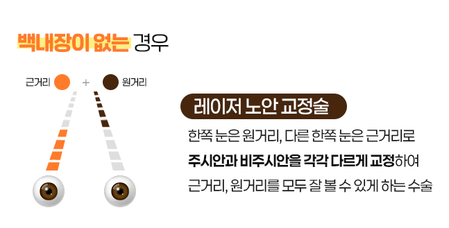 노안스마일라식가격 설명 시, 수술 과정 설명 일부 내용 (모노비전)