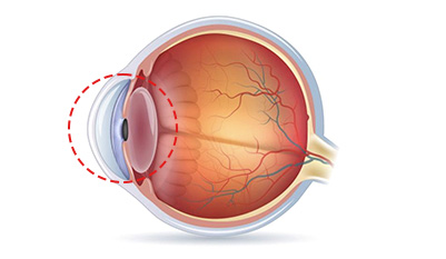 정상안 수정체 구조 이미지 — 투명한 수정체가 빛을 정확히 굴절시켜 망막에 초점을 맞추는 건강한 눈의 상태를 나타냄.
