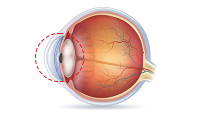 백내장 수정체 이미지 — 혼탁해진 수정체로 인해 빛이 제대로 통과하지 못해 시야가 흐려지는 백내장의 발생 원리를 보여주는 그림.