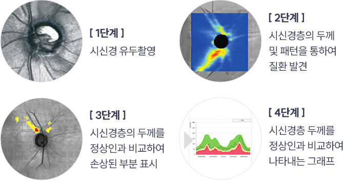녹내장 정밀 검사 단계 이미지 — 시신경 유두촬영, 시신경층 두께 및 패턴 분석, 정상인과 비교한 손상 부위 표시, 그래프 분석을 통해 시신경 손상 여부를 진단하는 과정을 설명함.