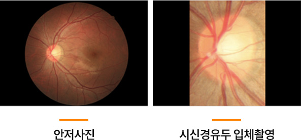 녹내장 검사 안저사진과 시신경유두 입체촬영 이미지 — 시신경 손상 여부와 시야 결손 진행 정도를 확인하기 위한 정밀 안과 검사 과정.