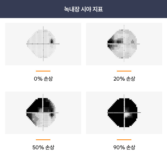 녹내장 시야 지표 비교 이미지 — 시신경 손상 정도에 따른 시야 손실 변화를 0%, 20%, 50%, 90% 단계로 나타내어 녹내장의 진행 상태를 시각적으로 보여줌.