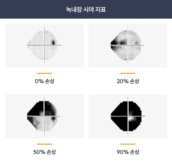 녹내장 시야 지표 비교 이미지 — 시신경 손상 정도에 따른 시야 손실 변화를 0%, 20%, 50%, 90% 단계로 나타내어 녹내장의 진행 상태를 시각적으로 보여줌.