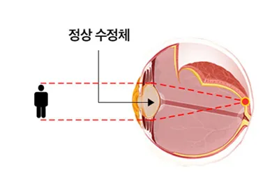 정상 수정체의 초점 형성 이미지 — 건강한 수정체가 빛을 굴절시켜 망막 위에 정확히 초점을 맞추는 정상 시력 상태를 나타냄.