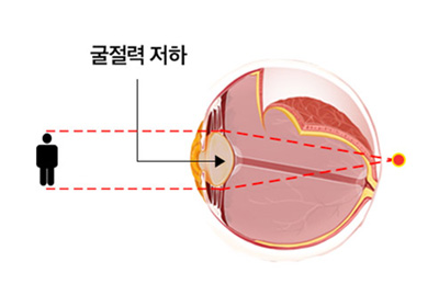 노안으로 인한 굴절력 저하 이미지 — 수정체의 조절력이 떨어져 빛의 초점이 망막 뒤에 형성되며 근거리 사물이 흐리게 보이는 상태를 설명함.
