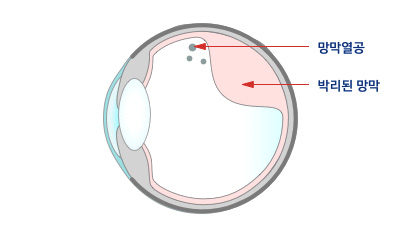 망막열공 단면도 이미지 — 망막에 구멍이 생기거나 일부가 박리되어 시야 손상과 시력 저하를 유발하는 망막열공의 진행 상태를 보여줌.