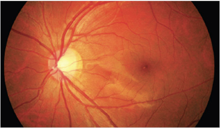 정상 안저 이미지 — 시신경과 망막 혈관이 뚜렷하게 보이는 건강한 눈의 안저 사진.