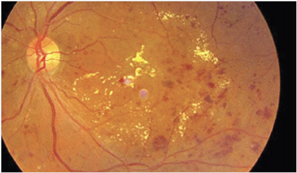 당뇨망막병증 안저 이미지 — 망막 내 출혈과 삼출물이 관찰되는 당뇨 합병증으로, 시력 저하를 유발하는 당뇨망막병증의 특징적인 소견을 보여줌.