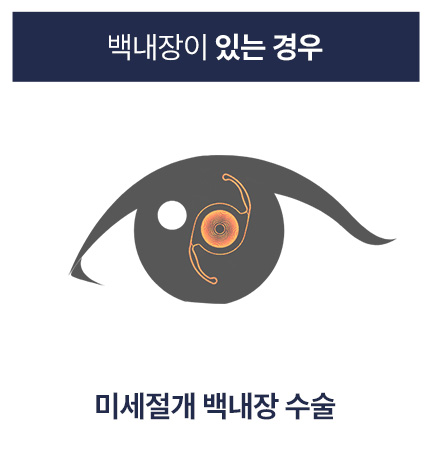 미세절개 백내장 수술: 백내장이 있는 경우 미세절개 백내장 수술 안내 이미지 — 혼탁한 수정체를 제거하고 인공렌즈를 삽입해 시력을 회복하는 백내장 수술 방법을 설명함.