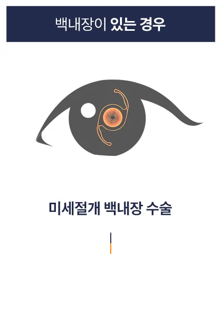 미세절개 백내장 수술: 백내장이 있는 경우 미세절개 백내장 수술 안내 이미지 — 혼탁한 수정체를 제거하고 인공렌즈를 삽입해 시력을 회복하는 백내장 수술 방법을 설명함.