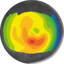 불규칙한 각막 표면 이미지