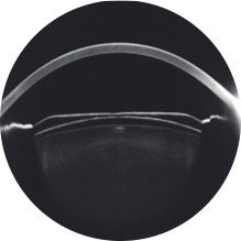 각막 두께 검사 이미지