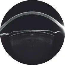 각막 두께 검사 이미지