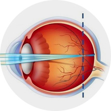 안구 길이를 나타내는 눈의 구조 단면도