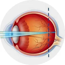 안구 길이를 나타내는 눈의 구조 단면도