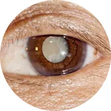 뿌옇게 변한 수정체를 보여주는 이미지