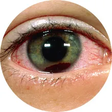 안구 건조로 인해 충혈된 눈 이미지