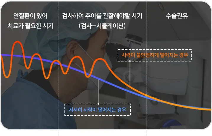 시력 변화 추이 그래프 이미지 — 서서히 시력이 저하되는 경우와 불안정하게 급격히 떨어지는 경우를 비교해, 검사 및 시뮬레이션 시기와 수술 권유 시점을 설명함.