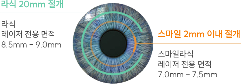 라식 20mm 절개 vs 스마일라식 2mm 이하 절개 비교 — 스마일라식은 각막 절편을 만들지 않아 회복이 빠르고 통증이 적은 수술.