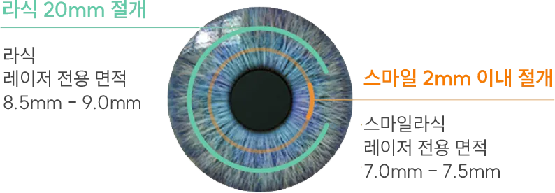 라식 20mm 절개 vs 스마일라식 2mm 이하 절개 비교 — 스마일라식은 각막 절편을 만들지 않아 회복이 빠르고 통증이 적은 수술.