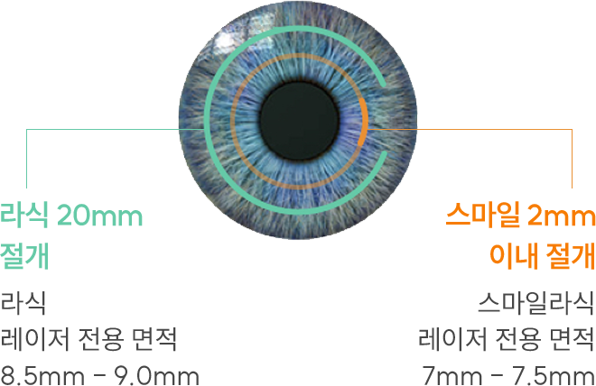 라식 20mm 절개 vs 스마일라식 2mm 이하 절개 비교 — 스마일라식은 각막 절편을 만들지 않아 회복이 빠르고 통증이 적은 수술.