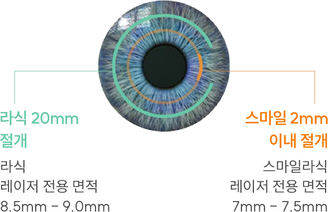 라식 20mm 절개 vs 스마일라식 2mm 이하 절개 비교 — 스마일라식은 각막 절편을 만들지 않아 회복이 빠르고 통증이 적은 수술.