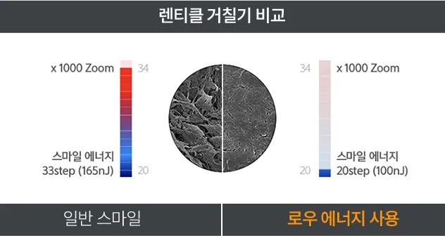 스마일라식 렌티클 거칠기 비교 이미지 — 일반 스마일 수술 대비 로우 에너지(100nJ, 20step) 사용 시 각막 절단면이 매끄럽고 조직 손상이 적은 것을 보여줌.