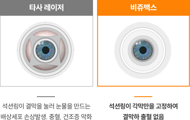 타사 레이저와 비쥬맥스 레이저 비교 이미지 — 타사 레이저는 결막을 눌러 출혈과 건조증 위험이 있지만, 비쥬맥스는 각막만을 고정해 결막 출혈 없이 안전한 수술이 가능함.