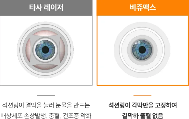 타사 레이저와 비쥬맥스 레이저 비교 이미지 — 타사 레이저는 결막을 눌러 출혈과 건조증 위험이 있지만, 비쥬맥스는 각막만을 고정해 결막 출혈 없이 안전한 수술이 가능함.