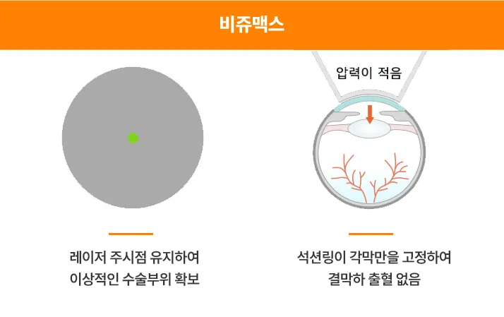 타사 레이저와 비쥬맥스 레이저 비교 이미지 — 타사 레이저는 결막을 눌러 출혈과 건조증 위험이 있지만, 비쥬맥스는 각막만을 고정해 결막 출혈 없이 안전한 수술이 가능함.