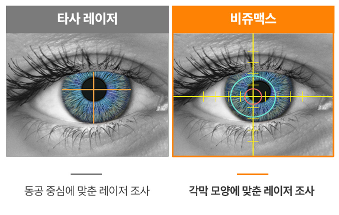타사 레이저와 비쥬맥스 레이저 비교 이미지 — 타사 레이저는 결막을 눌러 출혈과 건조증 위험이 있지만, 비쥬맥스는 각막만을 고정해 결막 출혈 없이 안전한 수술이 가능함.