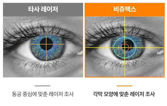 타사 레이저와 비쥬맥스 레이저 비교 이미지 — 타사 레이저는 결막을 눌러 출혈과 건조증 위험이 있지만, 비쥬맥스는 각막만을 고정해 결막 출혈 없이 안전한 수술이 가능함.