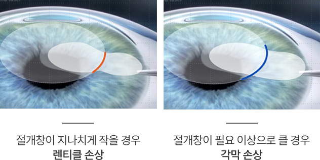 스마일라식 절개창 크기에 따른 부작용 비교 이미지 — 절개창이 작으면 렌티클 손상, 크면 각막 손상 위험이 커져 정밀한 절개 제어가 중요함.