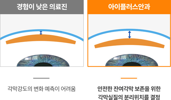 스마일라식 의료진 실력 비교 이미지 — 경험이 부족한 의료진은 각막강도 변화 예측이 어렵지만, 아이플러스안과는 안전한 잔여각막 보존을 위해 각막실질의 분리 위치를 정밀하게 결정함.”