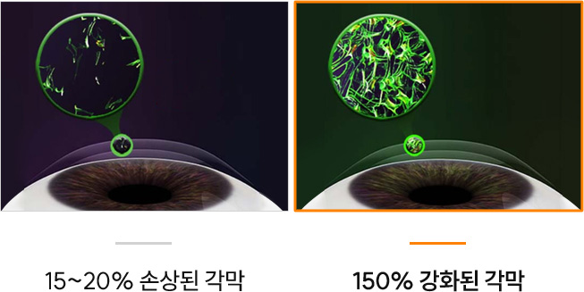 시력교정 수술 후 각막 조직 결합력 비교 이미지 — 일반 각막은 15~20% 손상된 상태이지만, CXL 치료 후 각막은 150%까지 강화되어 구조적 안정성과 시력 유지력이 향상됨.