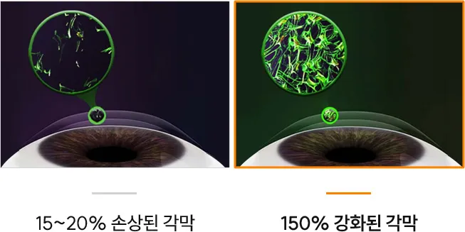 시력교정 수술 후 각막 조직 결합력 비교 이미지 — 일반 각막은 15~20% 손상된 상태이지만, CXL 치료 후 각막은 150%까지 강화되어 구조적 안정성과 시력 유지력이 향상됨.